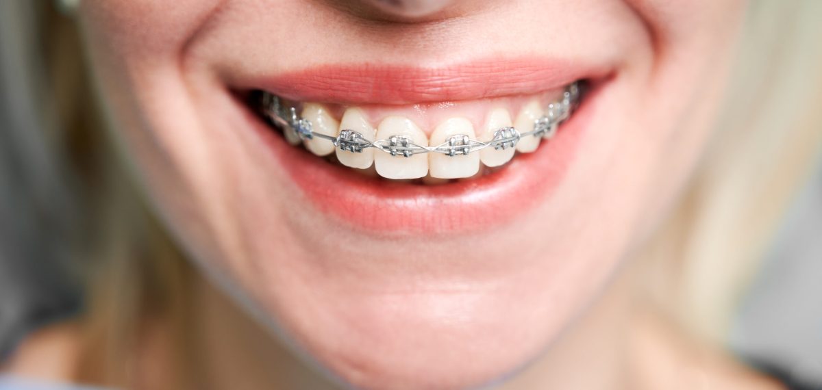 Close up of woman with charming smile demonstrating white teeth with orthodontic brackets. Female patient showing results of dental braces treatment. Concept of orthodontic treatment and dentistry.